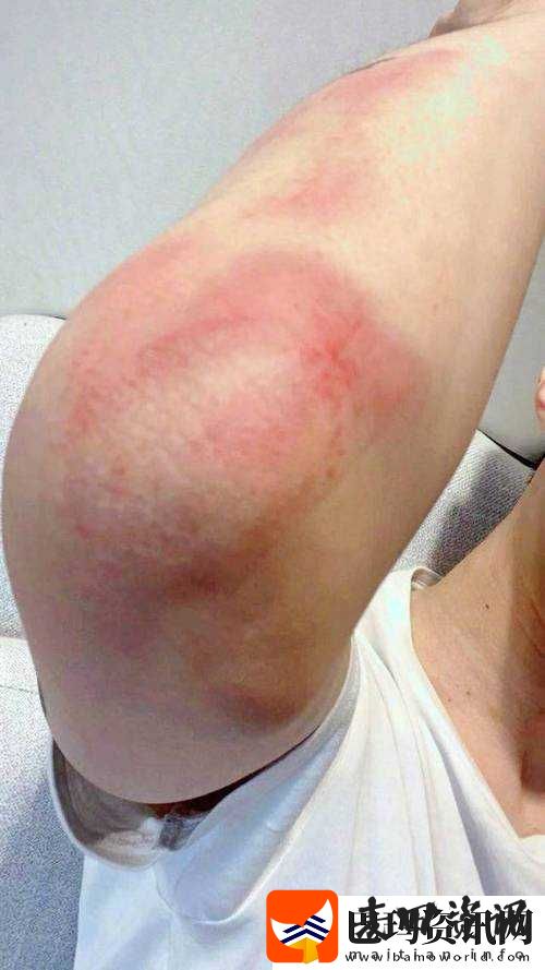 红肿疼痛小缝不能合拢